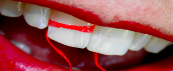 Dental floss around teeth