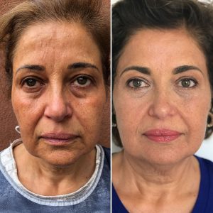 Before and after Facial aesthetics treatment
