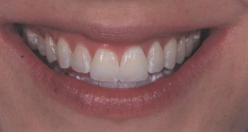 After ICON teeth whitening treatment