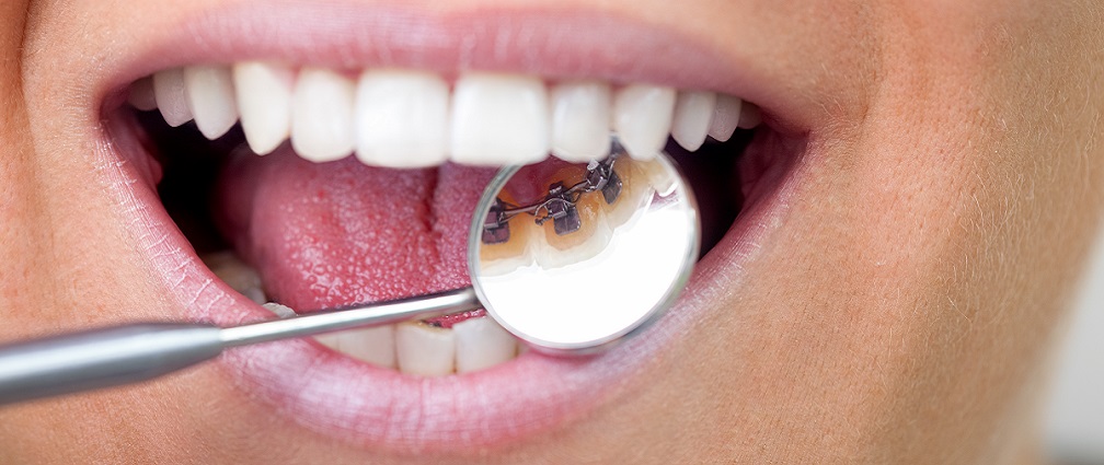 Lingual braces behind teeth and dental care
