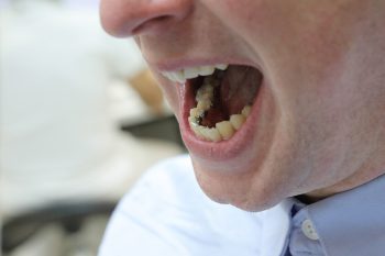 A close up of lingual braces behind teeth
