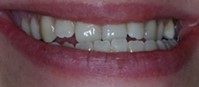 Bottom teeth closing over top teeth
